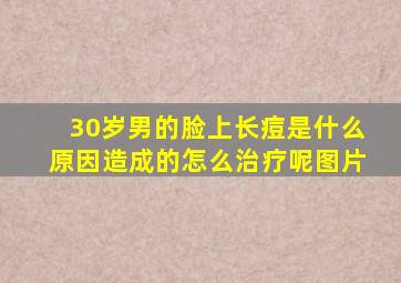 30岁男的脸上长痘是什么原因造成的怎么治疗呢图片