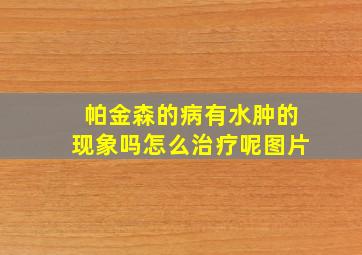 帕金森的病有水肿的现象吗怎么治疗呢图片