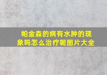 帕金森的病有水肿的现象吗怎么治疗呢图片大全