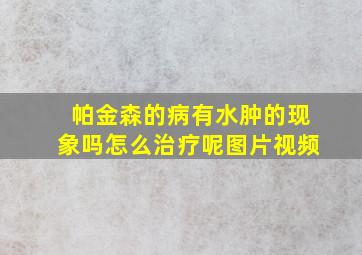 帕金森的病有水肿的现象吗怎么治疗呢图片视频