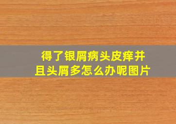 得了银屑病头皮痒并且头屑多怎么办呢图片