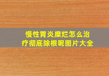 慢性胃炎糜烂怎么治疗彻底除根呢图片大全