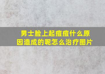 男士脸上起痘痘什么原因造成的呢怎么治疗图片