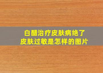 白醋治疗皮肤病绝了皮肤过敏是怎样的图片