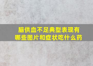 脑供血不足典型表现有哪些图片和症状吃什么药