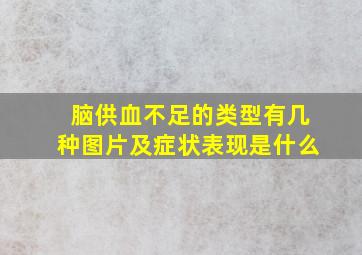 脑供血不足的类型有几种图片及症状表现是什么