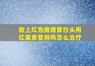 脸上红色痘痘冒白头用红霉素管用吗怎么治疗