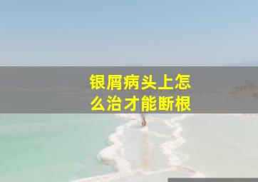 银屑病头上怎么治才能断根