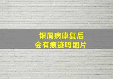 银屑病康复后会有痕迹吗图片