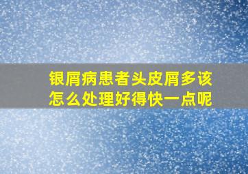 银屑病患者头皮屑多该怎么处理好得快一点呢