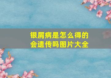 银屑病是怎么得的会遗传吗图片大全