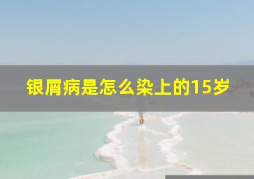 银屑病是怎么染上的15岁